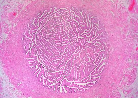 Blocked Fallopian Tube Caused By Tubal Disease