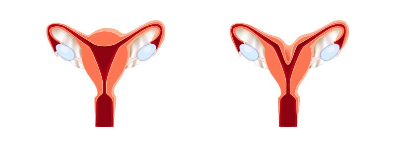 IVF with a Bicornuate Uterus